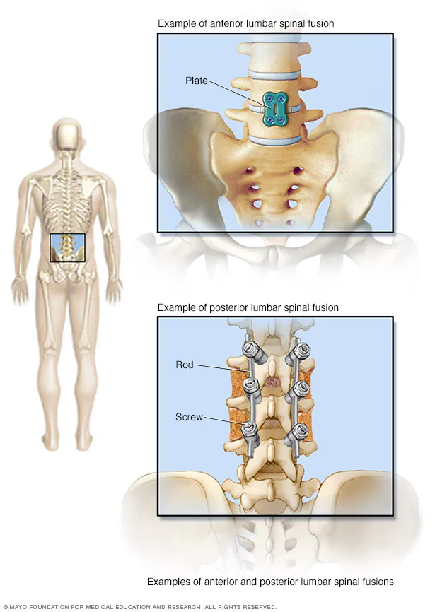 Spinal Fusion Surgery